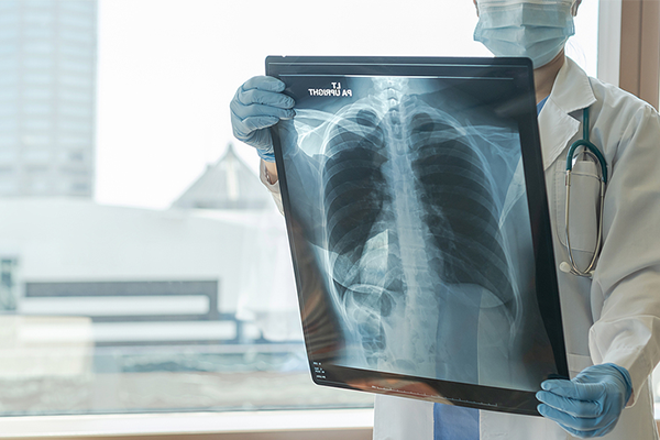 Physician looking at an x-ray of a patients lung